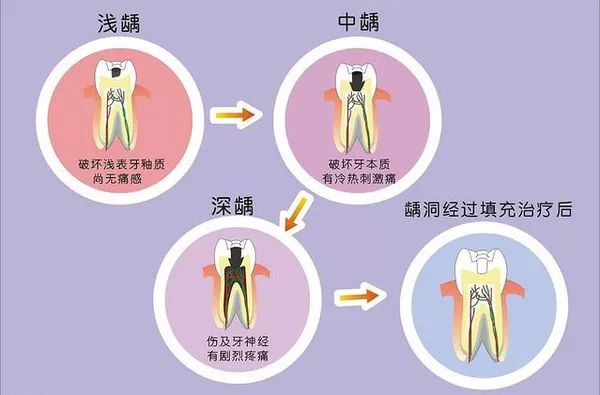 牙齿被蛀空了只剩牙根了,儿童牙齿被虫蛀空怎么办