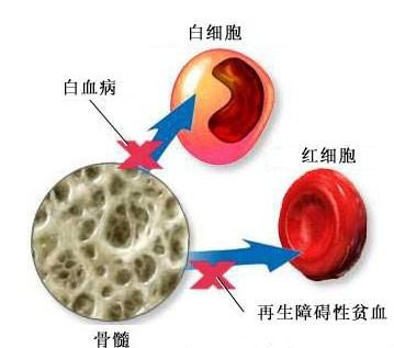 刘风再生障碍性贫血,再生再障性贫血有几种治疗方法