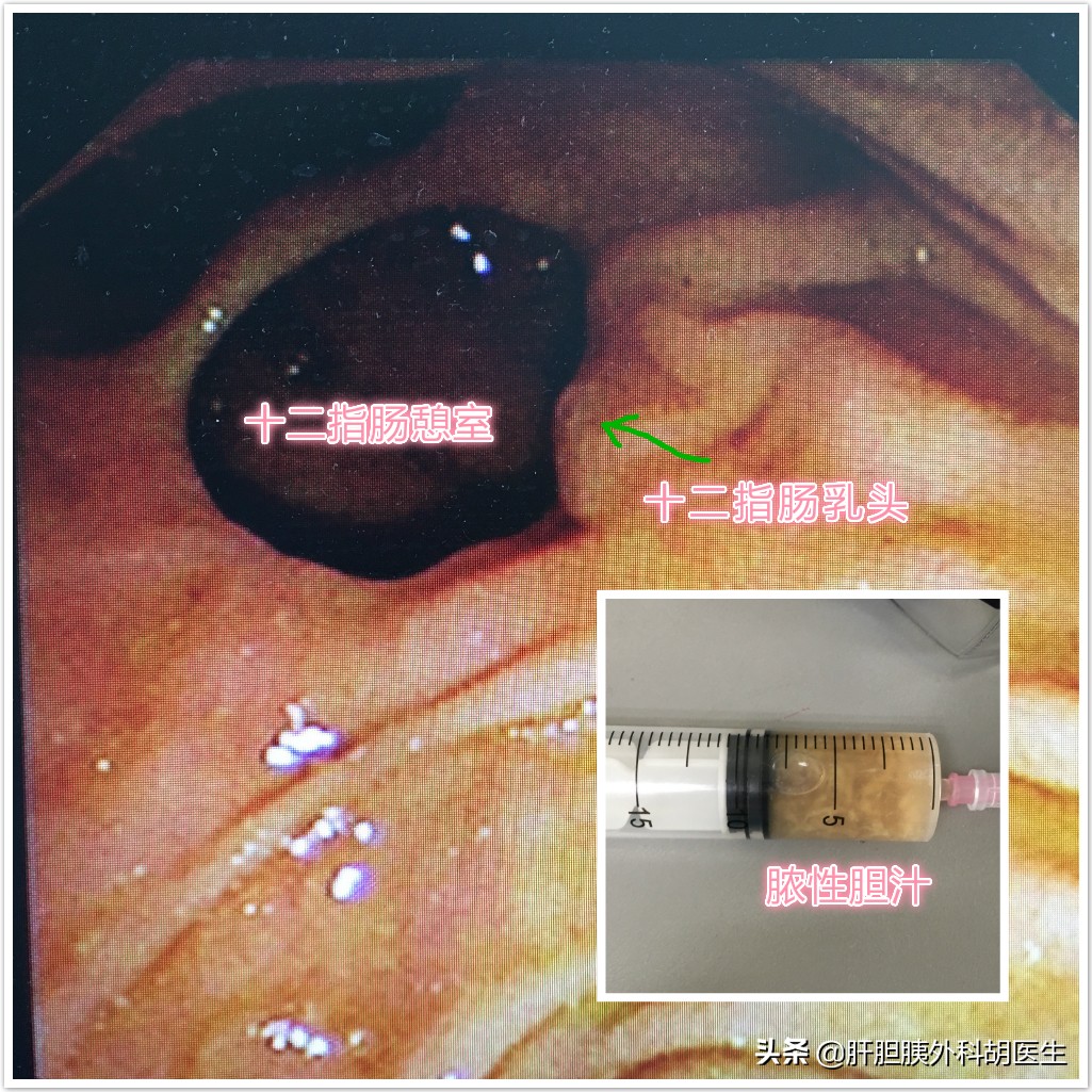 急性胆管炎应当怎么诊治,急性梗阻性化脓性胆管炎