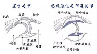疫情当下也要强身健体,疫情过后得了类风湿