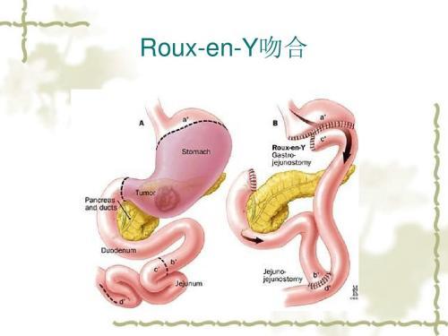 胆囊把胆汁输送到哪里,胆囊炎和胃病胆汁反流有区别吗