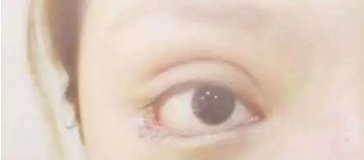 下三白眼长大后会改善吗,下三白眼的人如何手术矫正