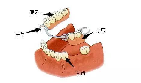 假牙吃到肚子里有什么坏处,把假牙吃到肚子的急救办法