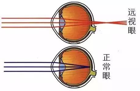 如何治疗眼部远视,远视眼治疗黄金期