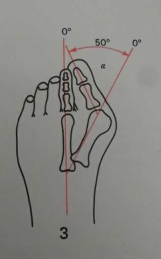 拇外翻大脚趾疼如何在家就能治,大脚拇指痛要警惕