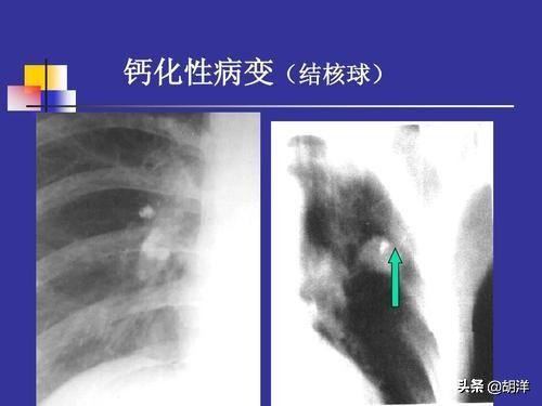 人体用浇灌“水泥”的方法封闭结核菌，只有这样才能算完全痊愈