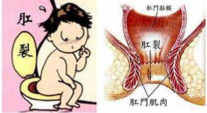 男性大便出血排除痔疮,拉屎肛裂出血是癌症吗