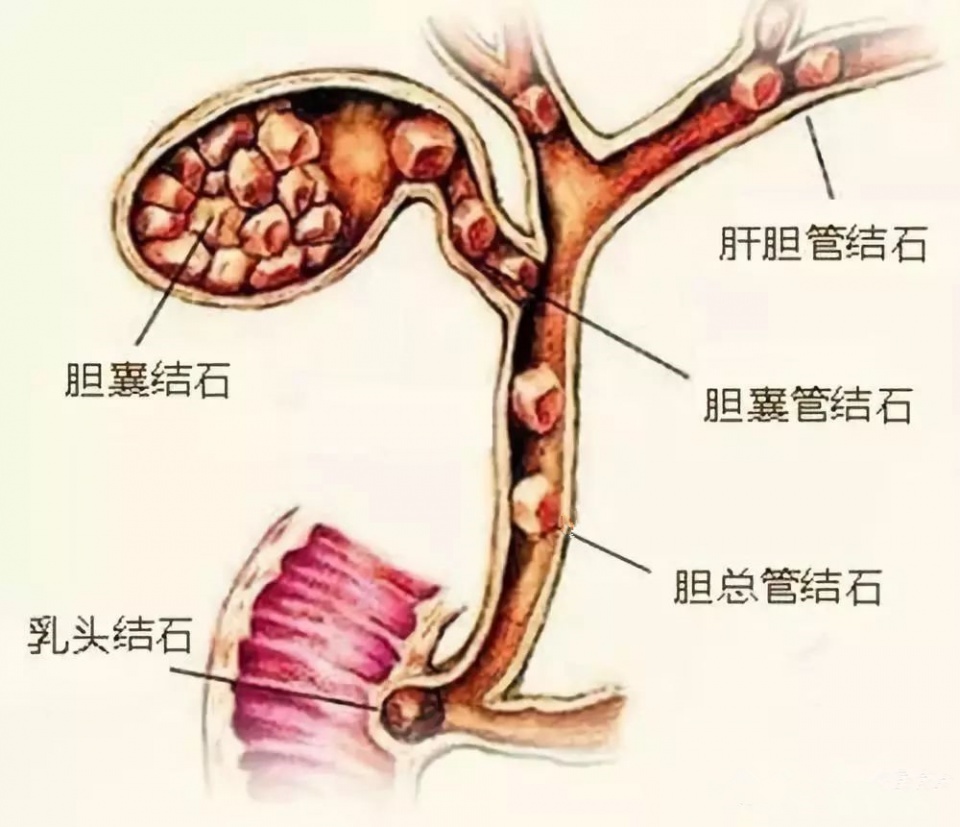 春天为什么胆结石会发作,胆结石疼痛一招解决