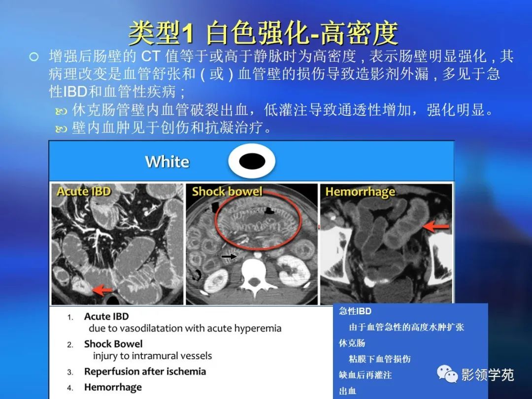 肠道内壁增厚,肠道扩张ct表现