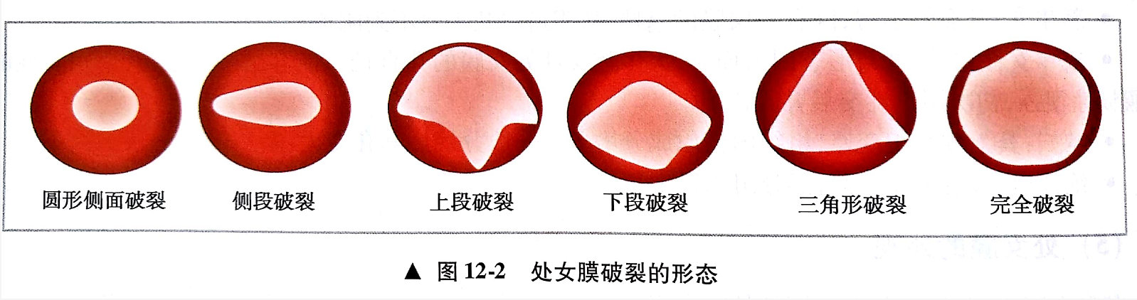 初次*生活性**不出血是否意味着女性不“洁白”么？