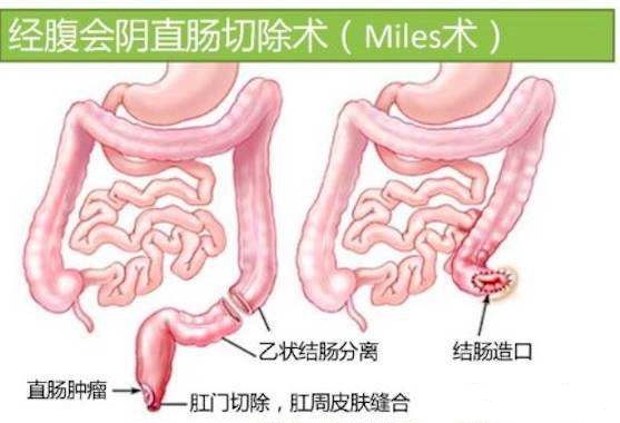 鑲涢棬瑜剁毐澶勬湁榛戠棧娌荤枟,鑲涢棬鍑虹幇榛戠棧瑕佹不鐤楀悧
