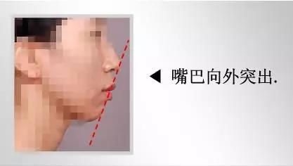 隆下巴后，整张脸都会变美了