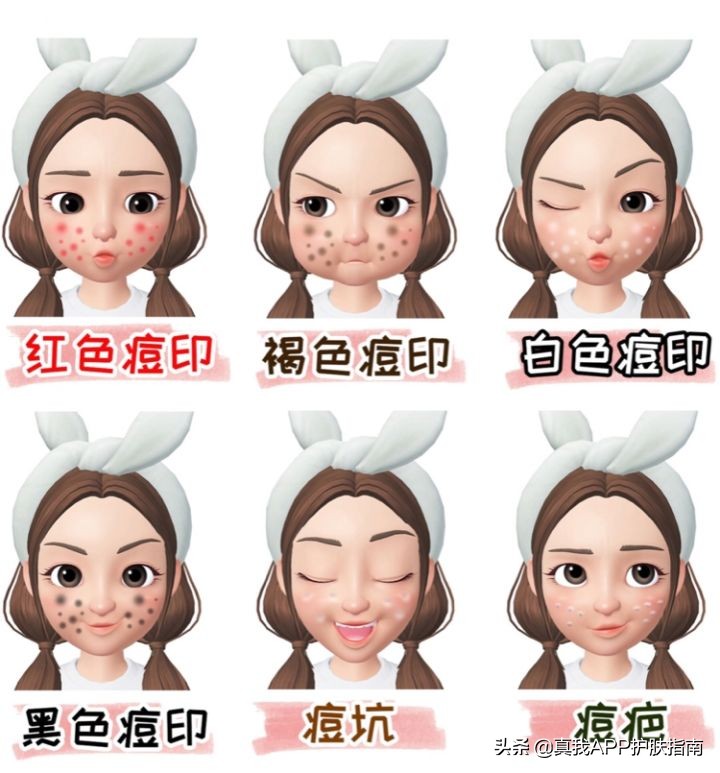 你脸上的痘印属于哪种？怎么形成的？又该怎么消除？