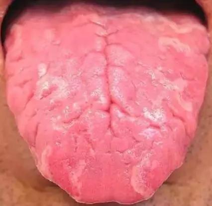舌头中间有裂纹边有齿痕怎么回事,舌头中间有裂纹边缘锯齿怎么回事