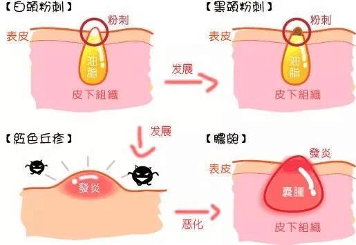 什么样的洗面奶可以祛痘控油美白,祛痘美白洗面奶什么牌子好