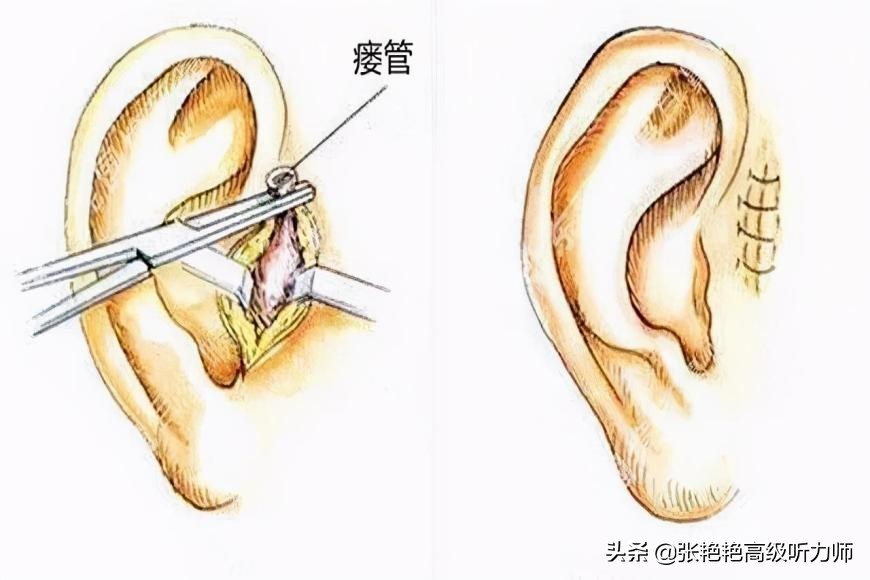 耳仓和拴马桩是什么,耳垂耳仓是富贵的征兆