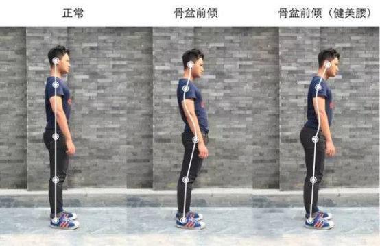 骨盆前倾的危害及矫正方法,骨盆前倾是怎样导致的怎么改善