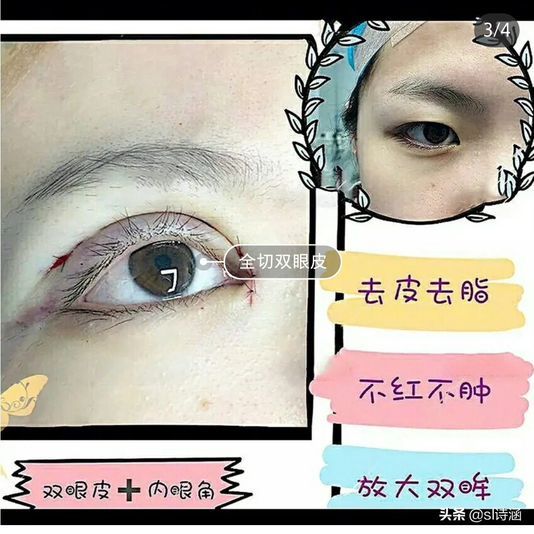 做完双眼皮之后有什么注意事项,做完双眼皮过后应当注意些什么