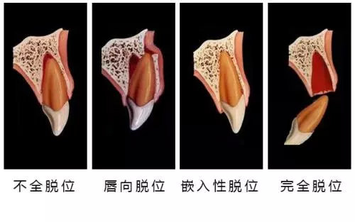 重度牙周炎是拔牙好还是治疗好,治疗牙周病需要拔除智齿吗