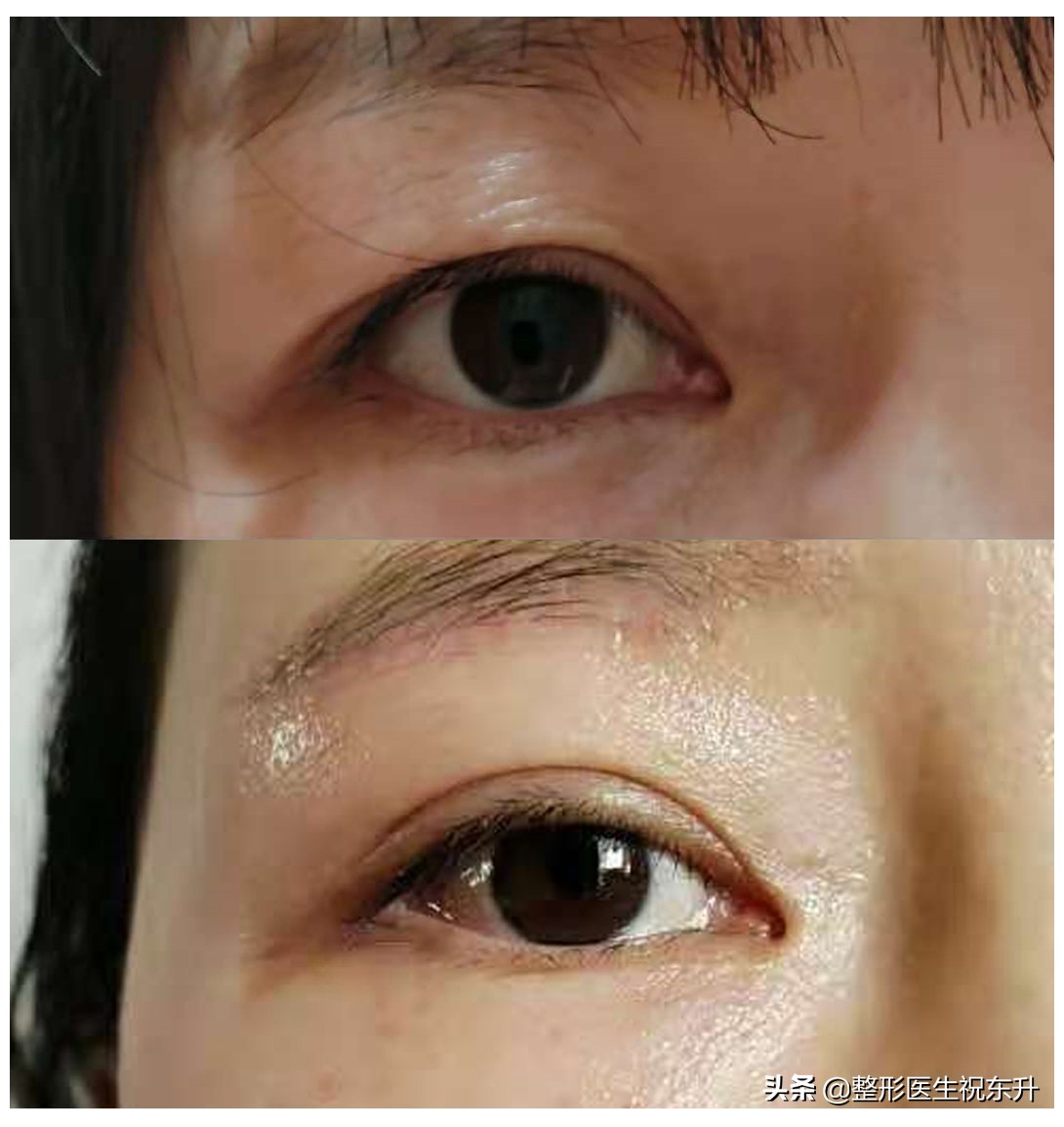 提眉手术害怕不害怕,做提眉手术有什么风险