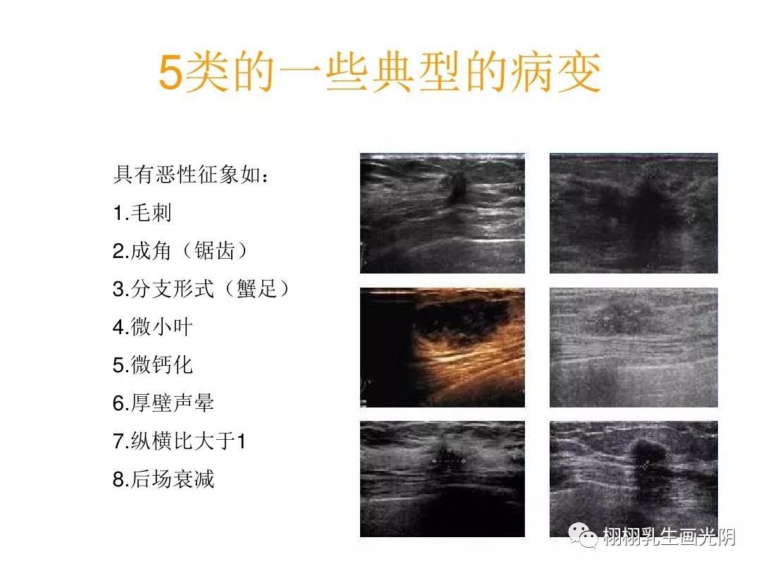 秒懂乳腺超声报告,秒懂超声系列