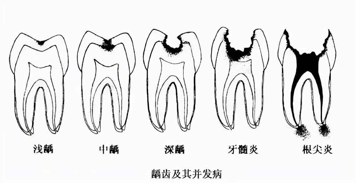 100元补的牙能坚持多少年,要根管治疗的牙久拖不治会如何
