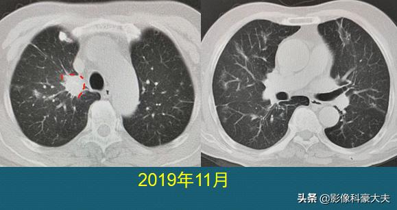 肺癌晚期脑转移用靶向药能活多久,肺癌晚期靶向治疗一般能活多少年