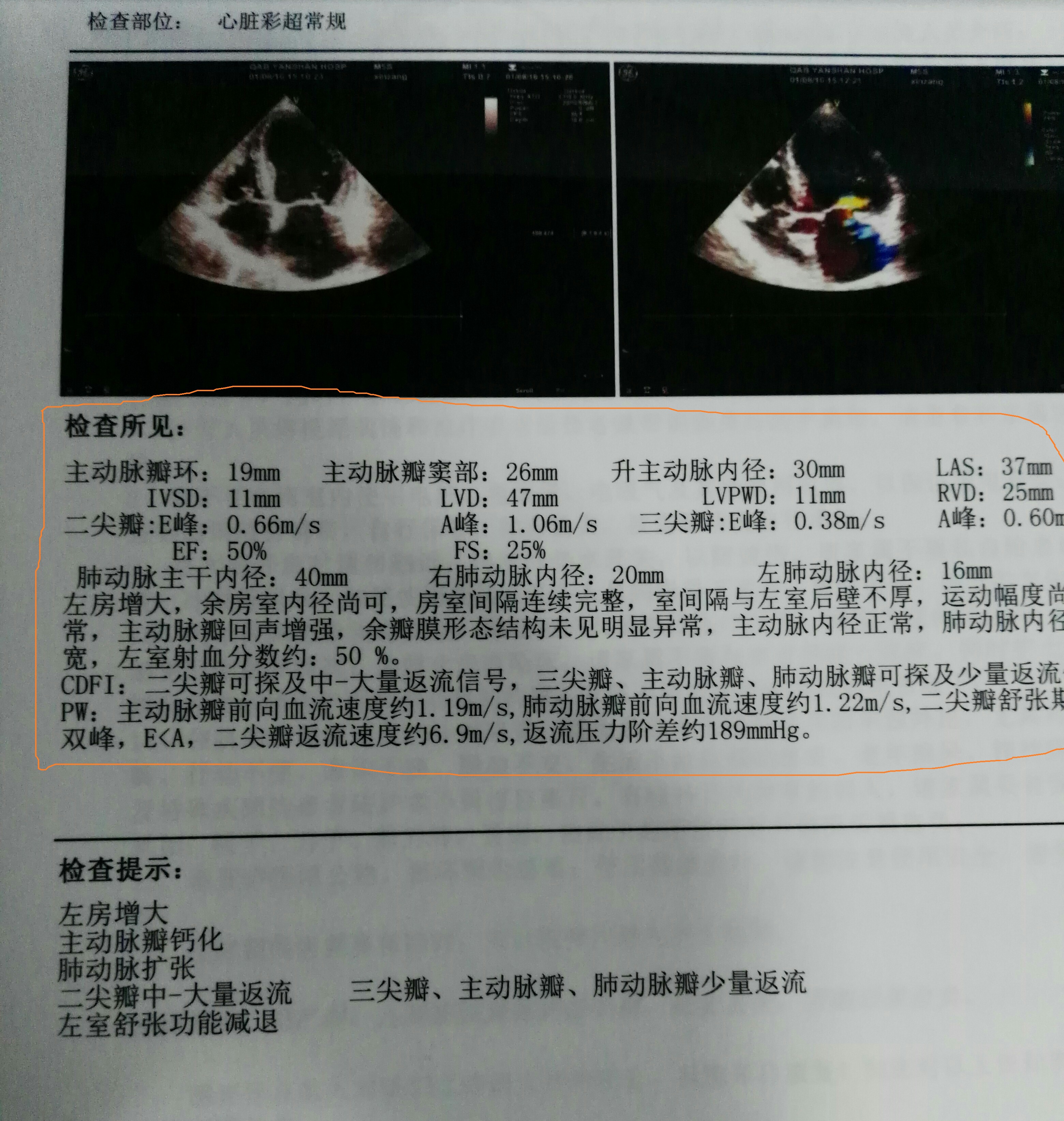 检查心脏心电图,检查心脏彩超是最好的吗
