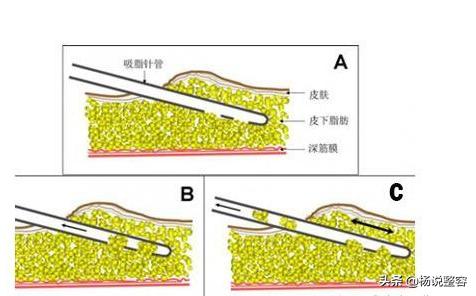 大腿吸脂找哪个医生做,大腿吸脂多久可以打瘦腿针