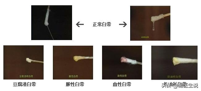 女性同志要长点心，阴道分泌物呈这6种颜色，就不能再同房了！