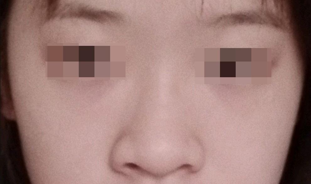 如何改善又红又黑的大鼻子,怎么样才能让鼻子越来越好看