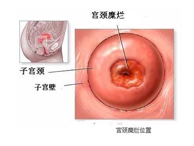 宫颈糜烂10分钟红光治疗危害,宫颈糜烂中医怎么治疗效果最好