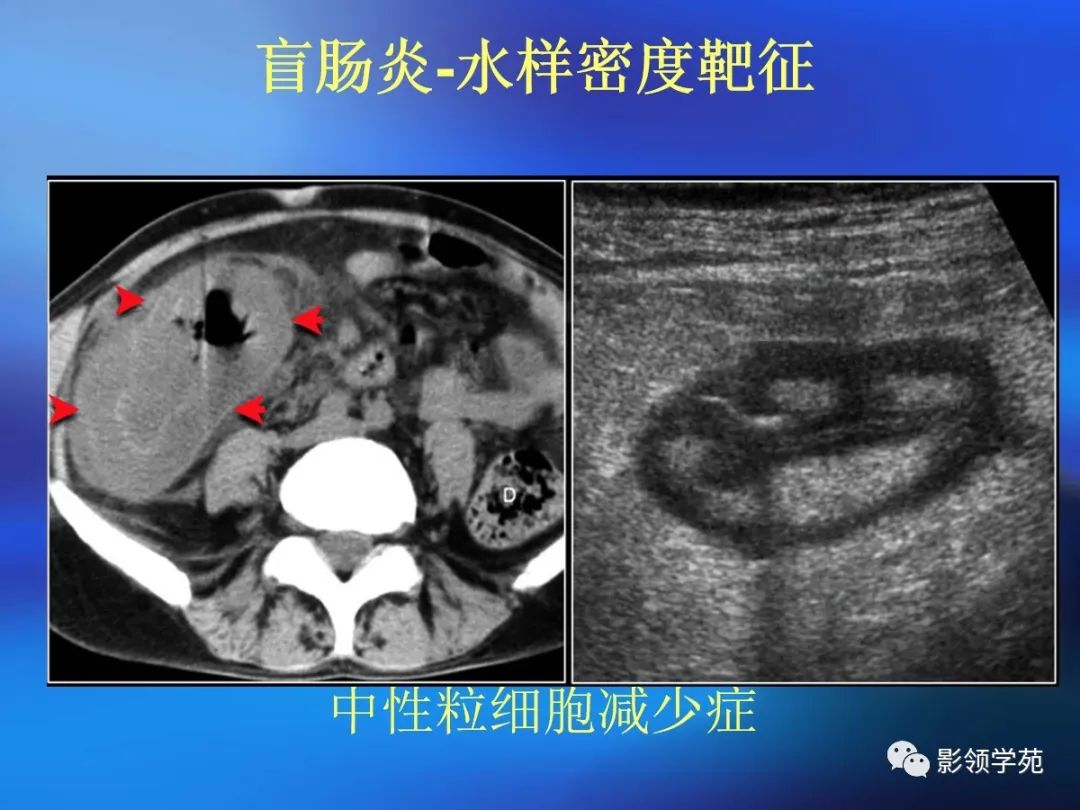 肠道内壁增厚,肠道扩张ct表现