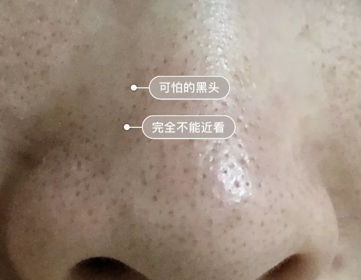 亲测真正有效去黑头粉刺产品,黑头连根拔起还会再长吗