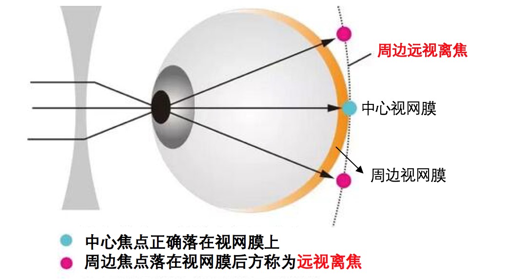儿童近视控制哪种效果好,近视可以配离焦镜片吗