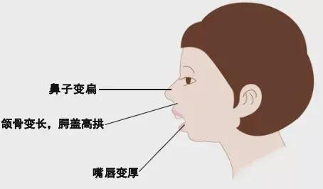 怎么和打呼的人一起睡,跟打呼的人在一起睡不着怎么办