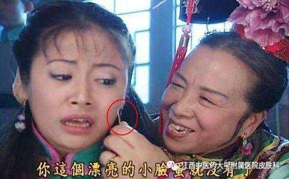 做了黄金微针可以挤痘痘吗,黄金微针可以永久性改善痘坑
