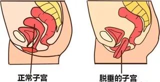 女性的子宫脱垂怎么治疗好,女性平常要怎么注意子宫脱垂
