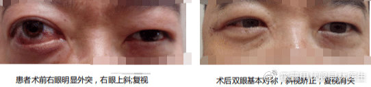 甲亢突眼怎么治疗能恢复正常,甲亢突眼最好治疗方法