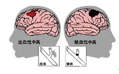 脑中风有什么症状表现,脑中风脑梗塞没有明显症状