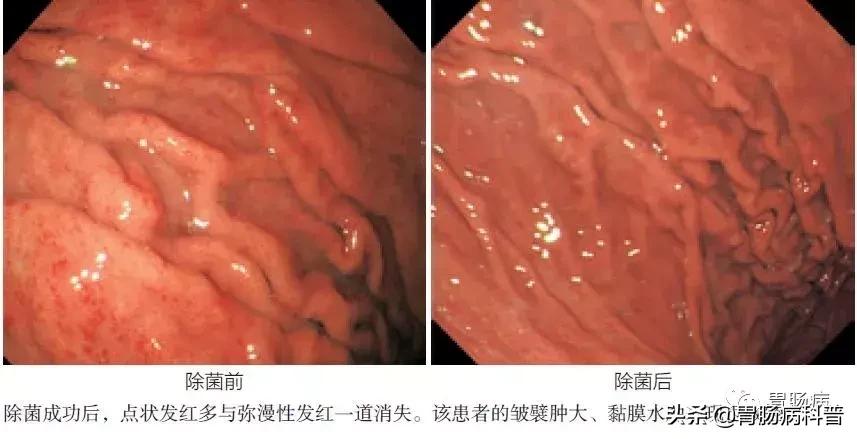 慢性非萎缩胃炎与浅表性胃炎区别,慢性非萎缩性胃炎浅表性胃炎区别