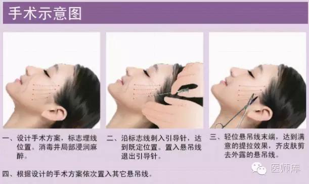什么是线雕美容过程,什么是线雕眉
