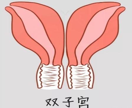 子宫畸形通过健身能改善吗,子宫畸形的最佳治疗方法