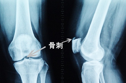 骨刺外翻什么症状,骨刺会导致拇指外翻吗