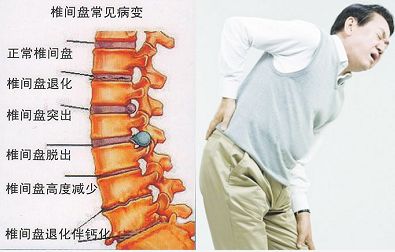 腰椎间盘突出不手术怎么治疗,腰椎间盘突出保守治疗是怎么治疗