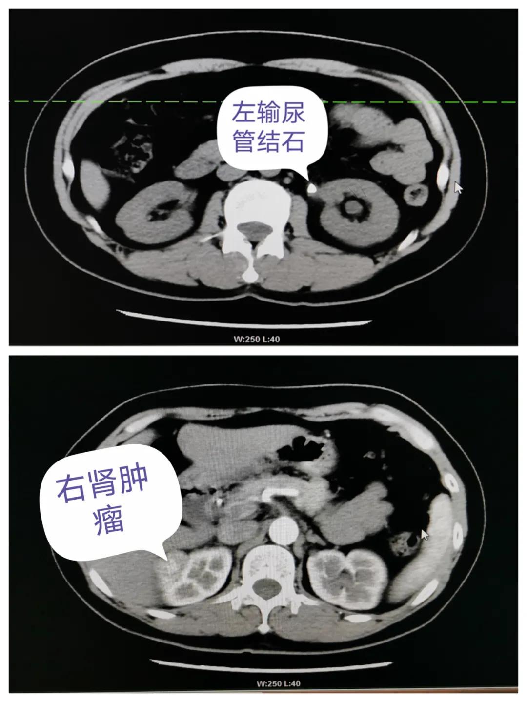 右肾占位和输尿管结石,肾癌症有什么医保用药