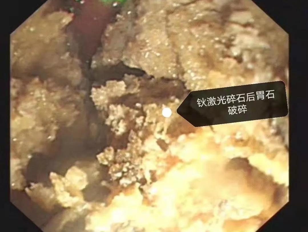 胃石症能吃什么药,胃石症有必要做手术治疗吗