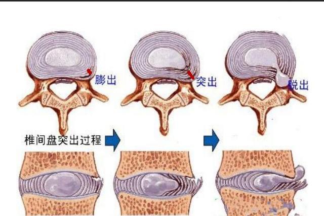 横叉练完回功了怎么办,练习横叉膝盖内侧疼痛