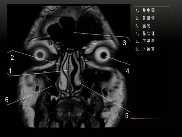 鼻腔鼻窦及颅底ct影像解剖,鼻窦解剖mri