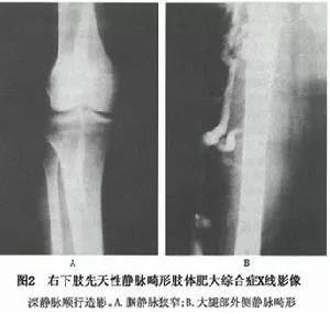 红胎记有时候明显有时候不明显,红胎记颜色浅容易治疗吗
